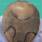 Greffe de cheveux en turquie