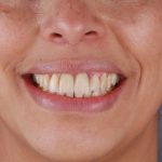 refaire ses dents en turquie
