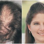 greffe de cheveux femme
