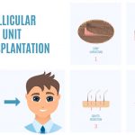 FUT hair loss treatment