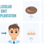 FUT hair loss treatment