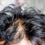 minoxidil
