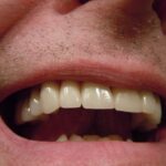 Quelles sont les conséquences d'une dent dévitalisée