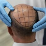 FUE Saphir greffe de cheveux