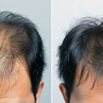 Before and After Hair Transplant Results on Male Patient.
