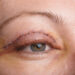 Blépharoplastie Turquie