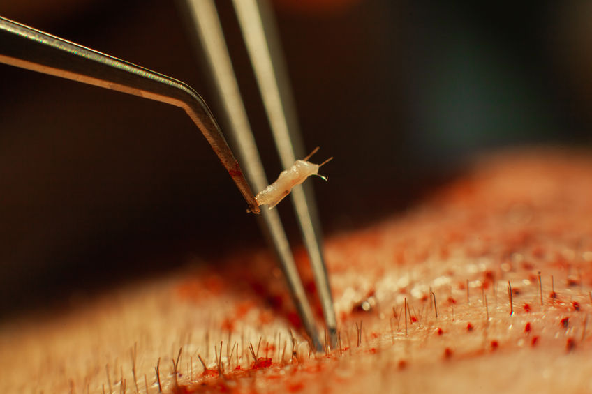 All-Inclusive Hair Transplant in Turkey – Istanbul, the Capital of Regrowth