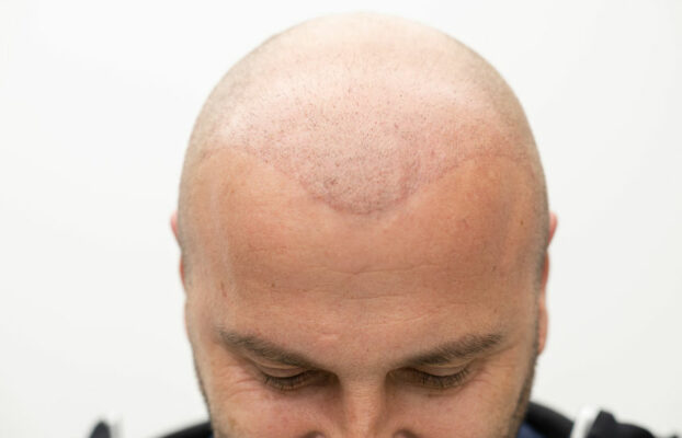 Soins post-transplant : astuces et conseils pour une repousse optimale