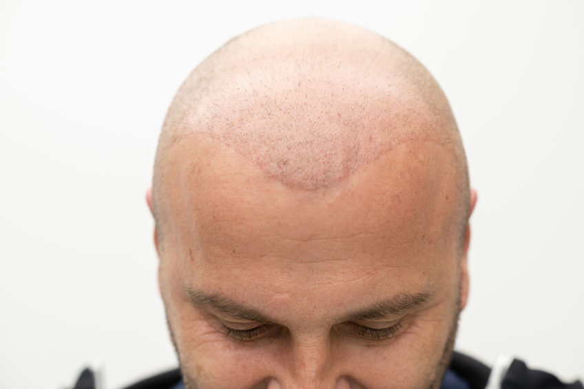 Soins post-transplant : astuces et conseils pour une repousse optimale