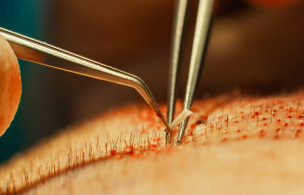 Hair Transplant Surgery: When the Case Is More Complex