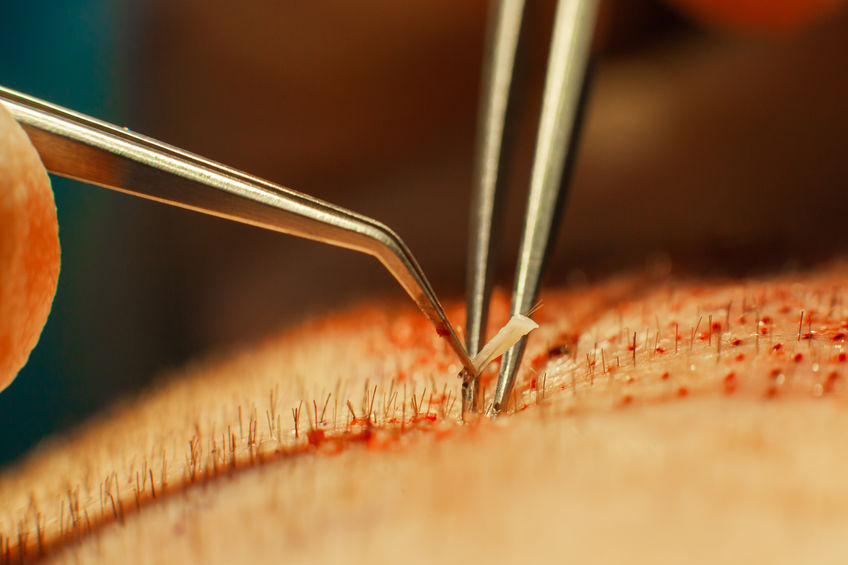 Hair Transplant Surgery: When the Case Is More Complex