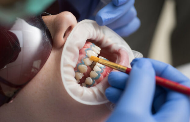 Facettes dentaires ou couronnes : quel choix faire ? Ce qu’il faut savoir !