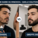 Greffe de barbe ou minoxidil