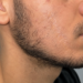 Greffe de barbe et cicatrices