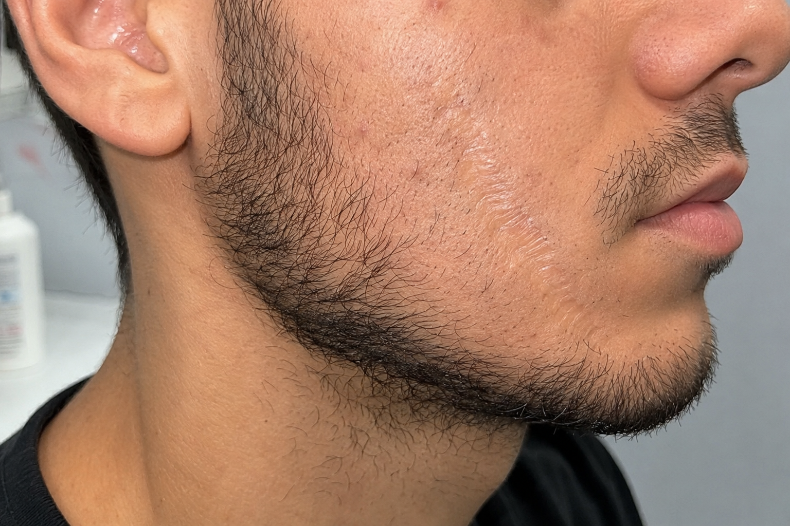Beard Transplant and Scars: Can a Burn or Mark Be Camouflaged?