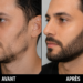 Greffe de barbe avant/après
